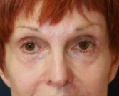Feel Beautiful - Injectable Filler in Lower Eyelids - After Photo